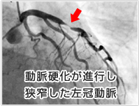 動脈硬化が進行し狭窄した左冠動脈